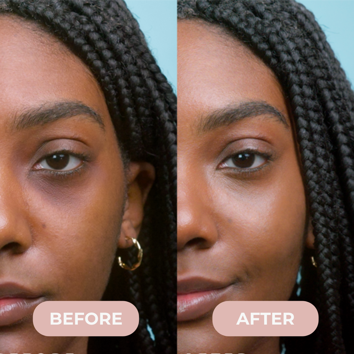 Velen™ Microneedle Eye Patches