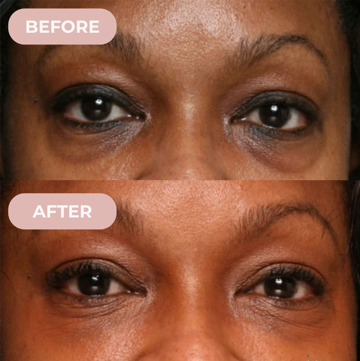 Velen™ Microneedle Eye Patches