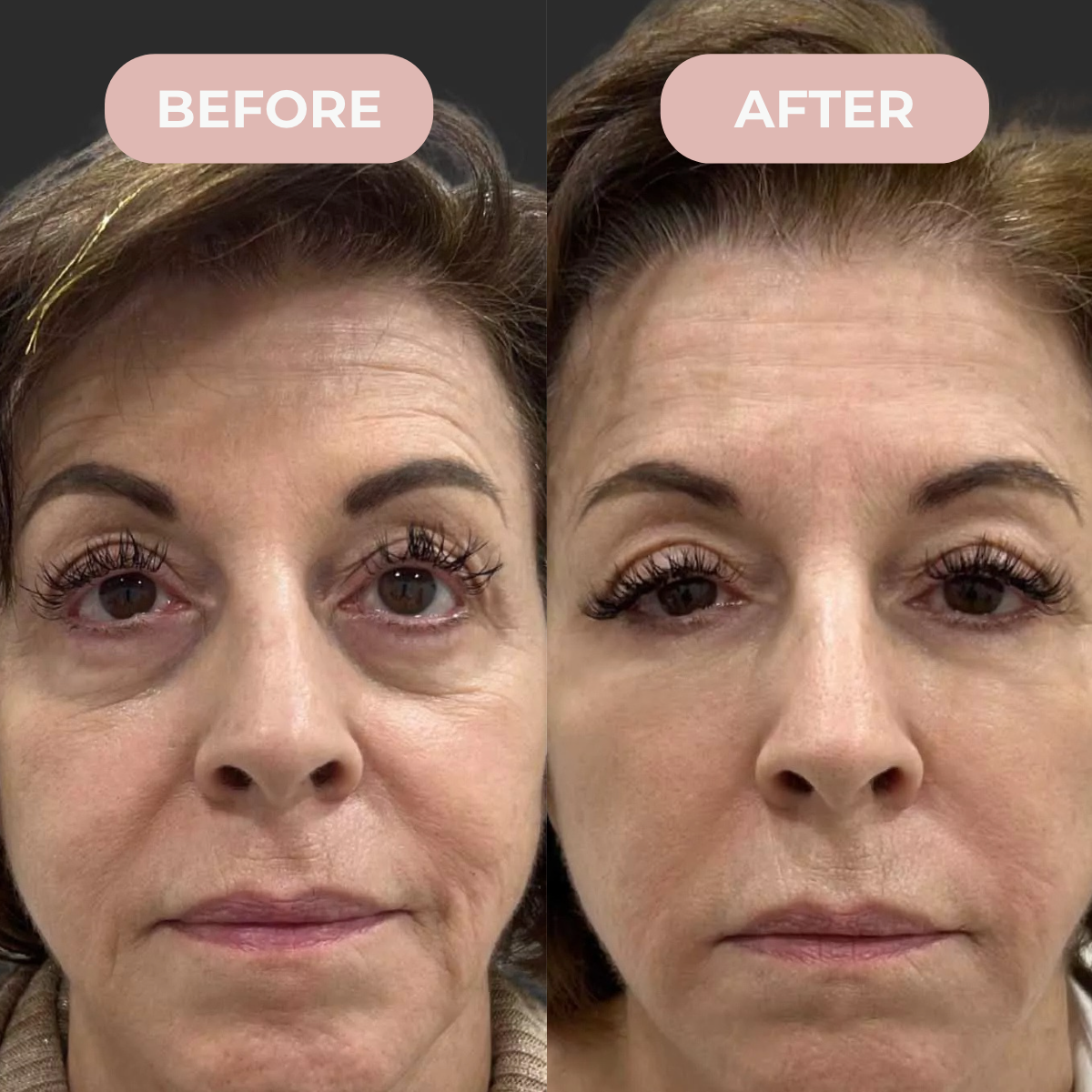 Velen™ Microneedle Eye Patches