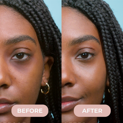 Velen™ Microneedle Eye Patches