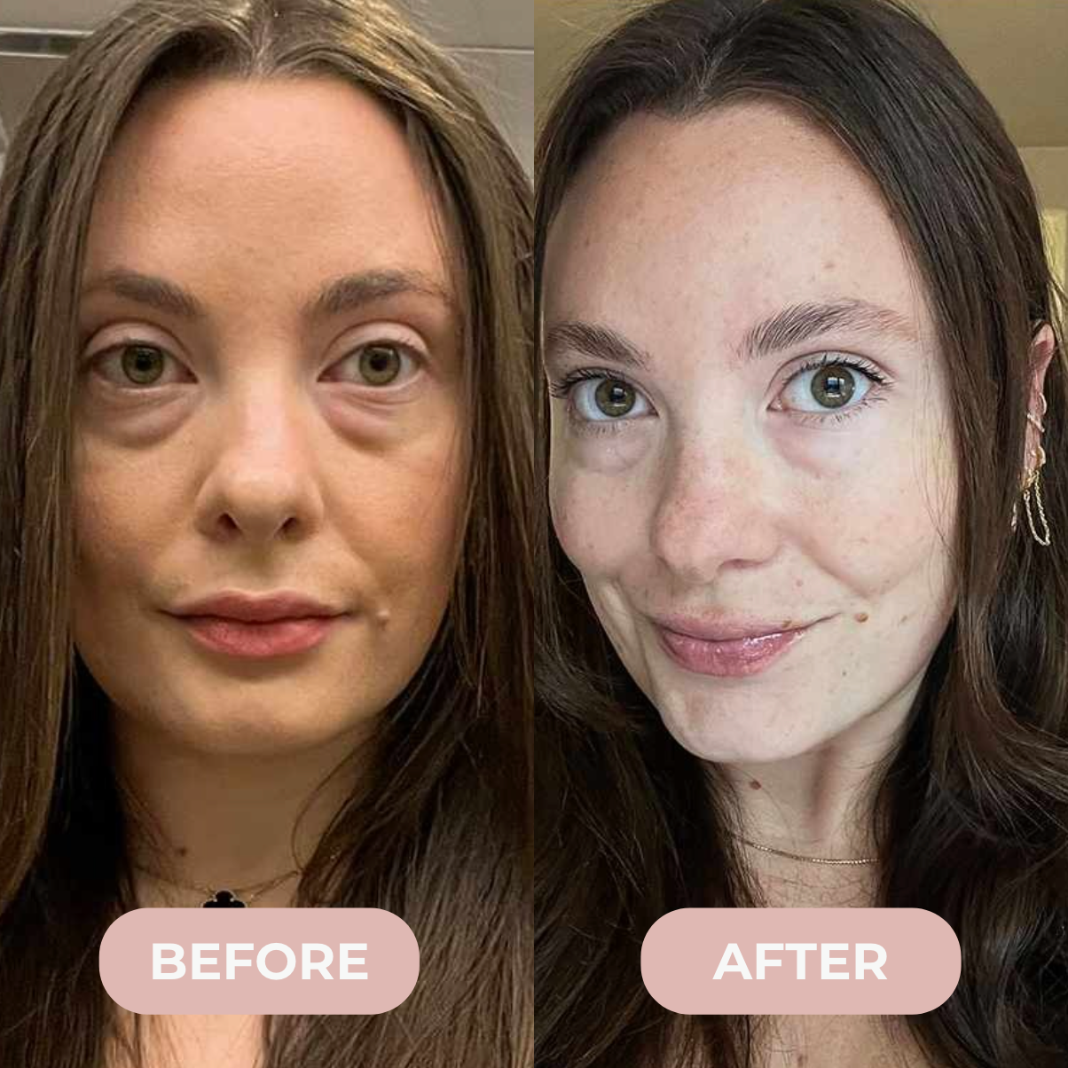 Velen™ Microneedle Eye Patches